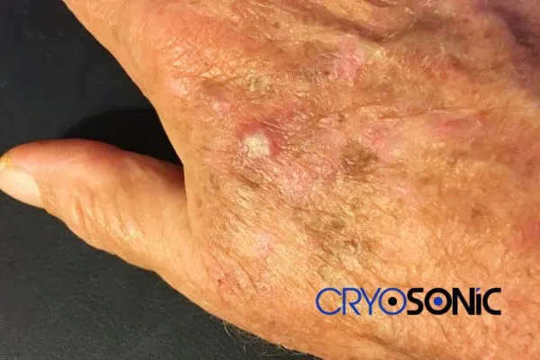 Book Your Actinic Keratosis removal Hemel Hempstead treatment Today Hemel Hempstead