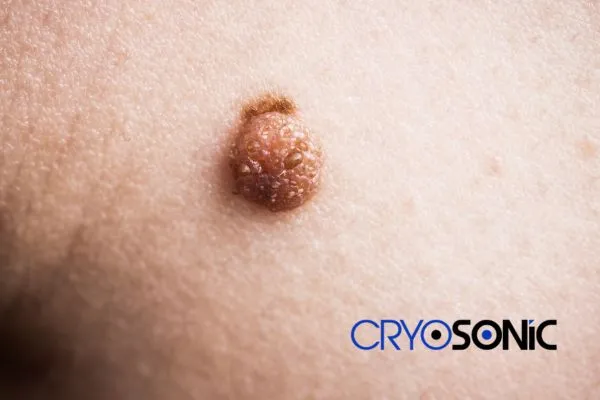 Are you looking for local Dermatofibroma Removal Bristol? Contact our team today in Hemel Hempstead