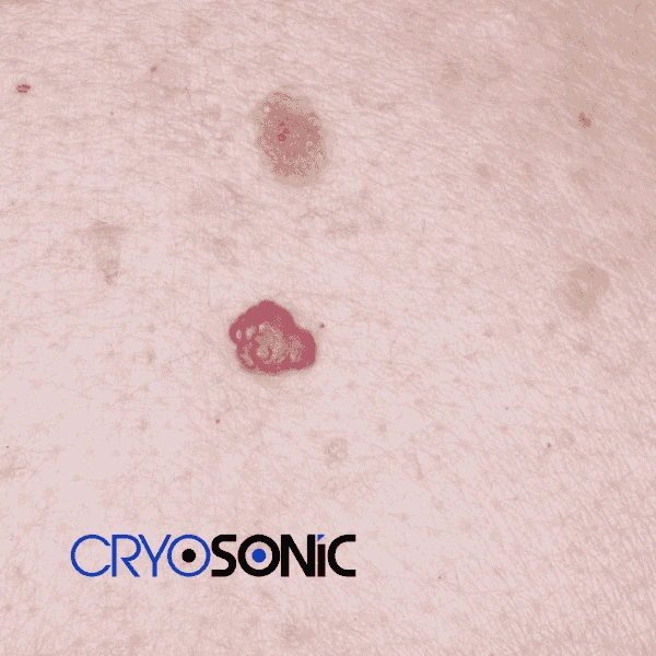 Looking for pain free cherry angioma removal treatment Hemel Hempstead? Call our team today! Hemel Hempstead