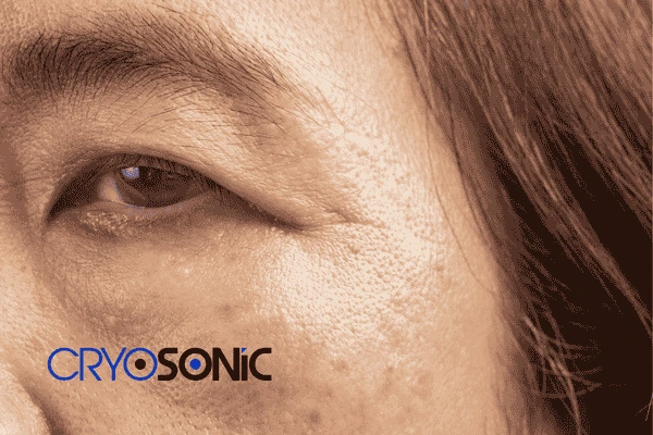 Start age spots removal Hemel Hempstead treatment today! Call our team now! Hemel Hempstead