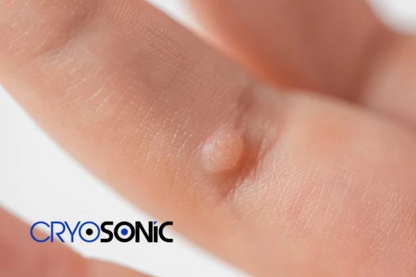 Contact Cryosonic today to learn more about us Hemel Hempstead now! Hemel Hempstead