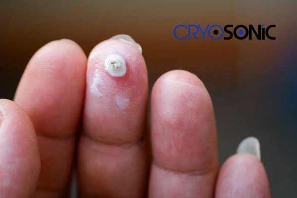 Learn more about us Hemel Hempstead at Cryosonic. Book in today! Hemel Hempstead