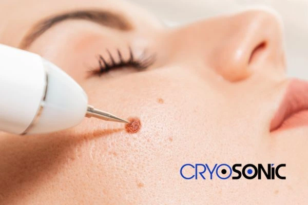 why choose us at Cryosonic for blemish removal? Find out more now Hemel Hempstead