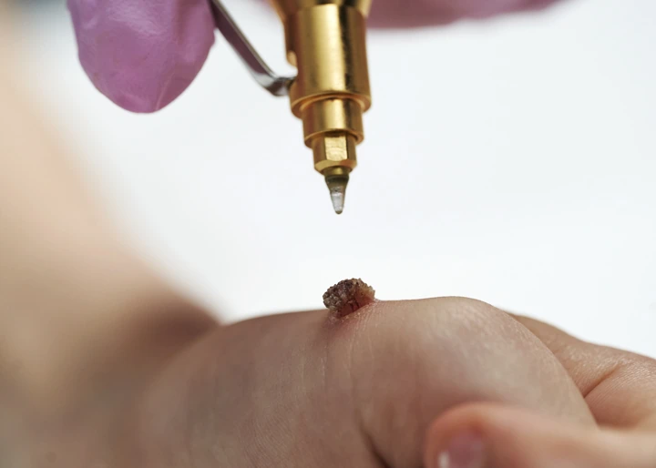 Cryopen For Children Bristol Hemel Hempstead