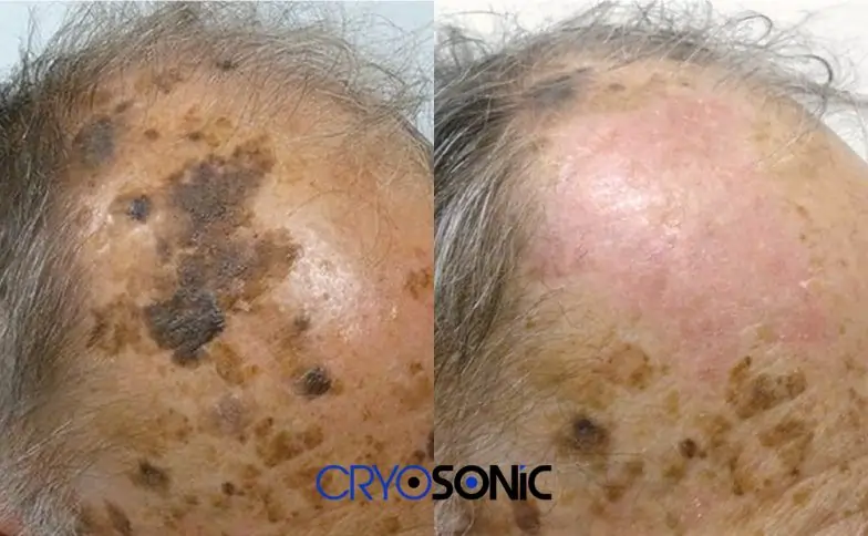 Seborrhoeic Keratosis Removal before and after Hemel Hempstead