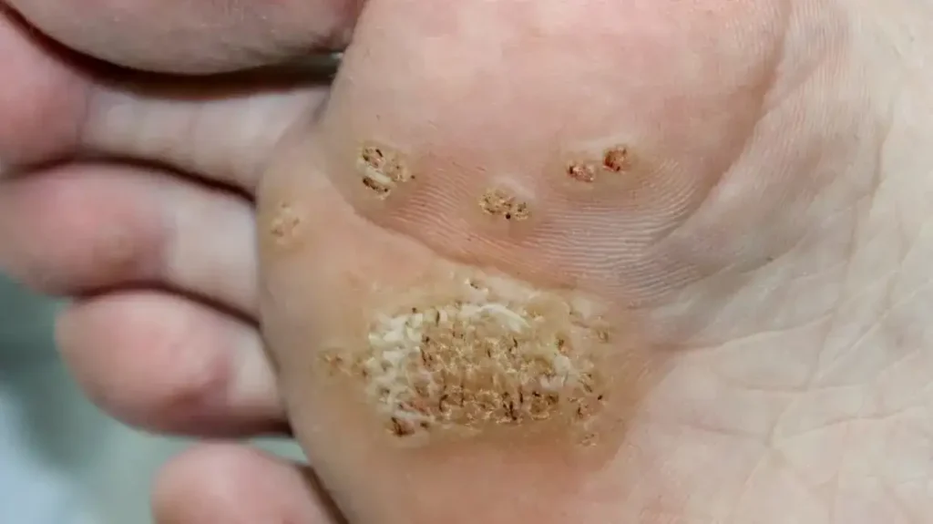 Secure Your Wart Removal Appointment with One Click Hemel Hempstead