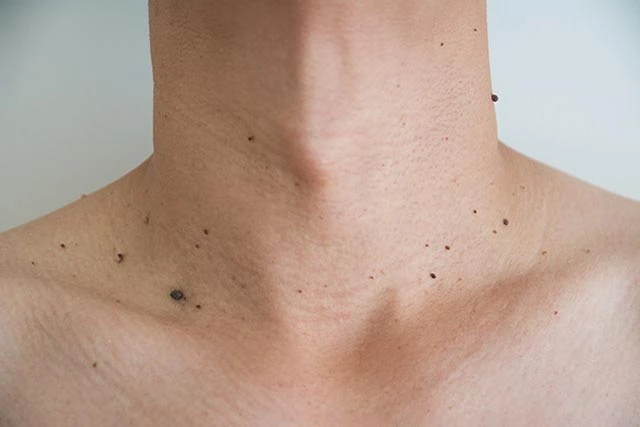 What to Avoid After Benign Mole Treatment in Hemel Hempstead Hemel Hempstead