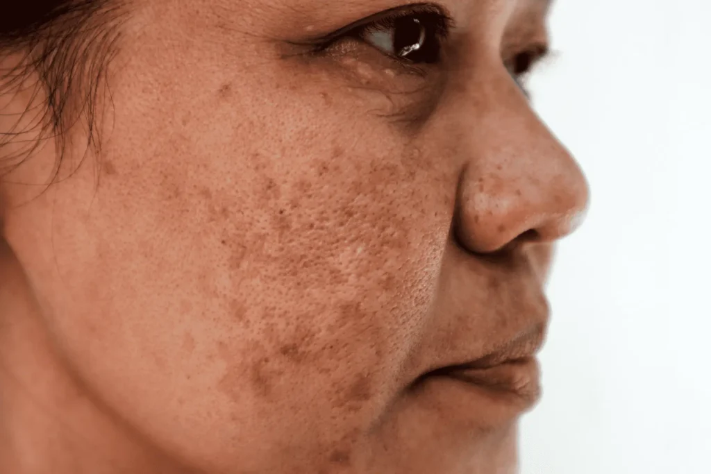 Aftercare Advice for Sun Damage Treatment Hemel Hempstead