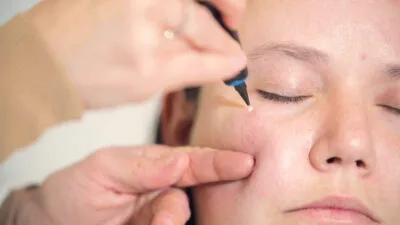 Aftercare Advice Following Milia Removal in Hemel Hempstead