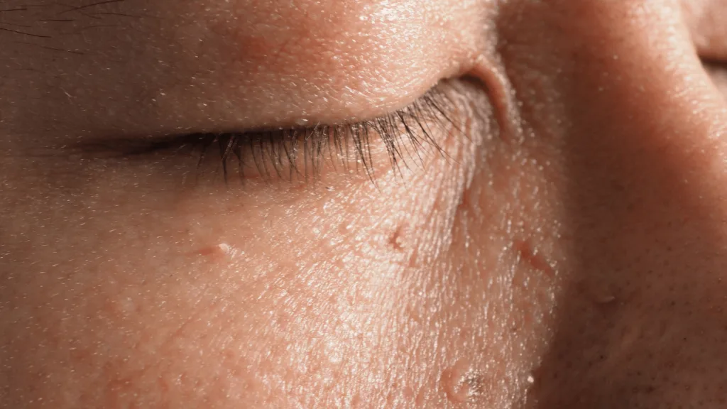 Frequently Asked Questions about Skin Tag Removal Hemel Hempstead