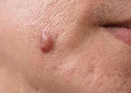 Skin Tags Recovery Time and Skin Healing Expectations Hemel Hempstead