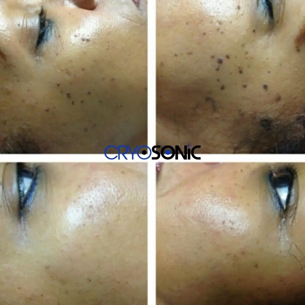 Why Skin Shows Pigmentation After Treatment Hemel Hempstead