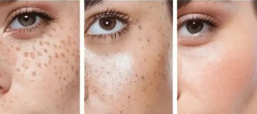 Ephelides Removal Results and Healing Timeline Hemel Hempstead