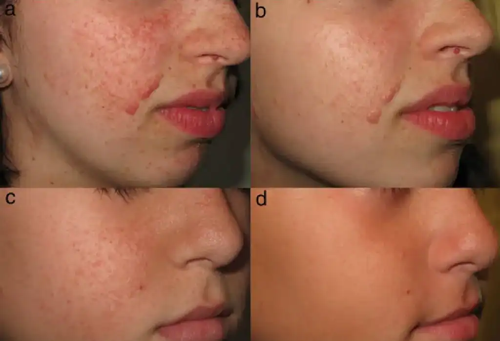 Frequently Asked Questions About Angiofibroma Hemel Hempstead Hemel Hempstead
