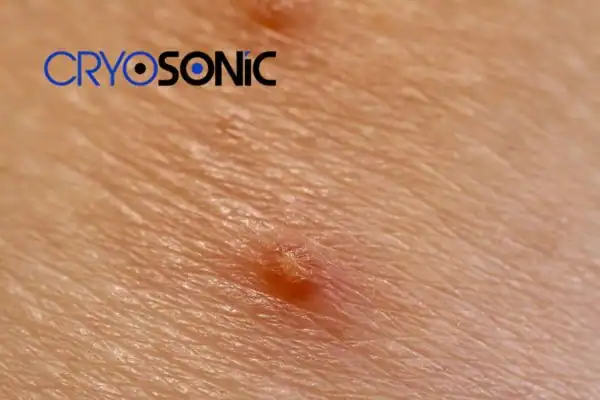 Molluscum Contagiosum Treatment Hemel Hempstead Hemel Hempstead
