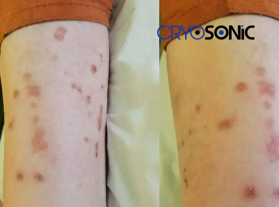 Recovery and Aftercare for Porokeratosis Treatment Hemel Hempstead Hemel Hempstead