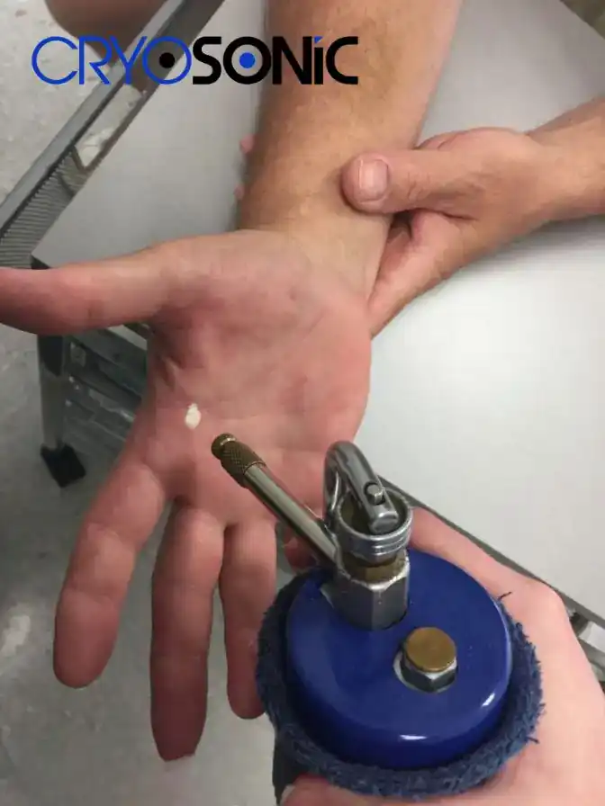Temperature Differences: OTC vs Medical-Grade Cryotherapy Hemel Hempstead